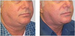 Precision Aesthetics Renews Its Commitment to Non-Surgical Body Shaping and Non- Surgical Fat Reduction with Exilis Elite Precision Aesthetics Renews Its Commitment to Non-Surgical Body Shaping and Non- Surgical Fat Reduction with Exilis Elite